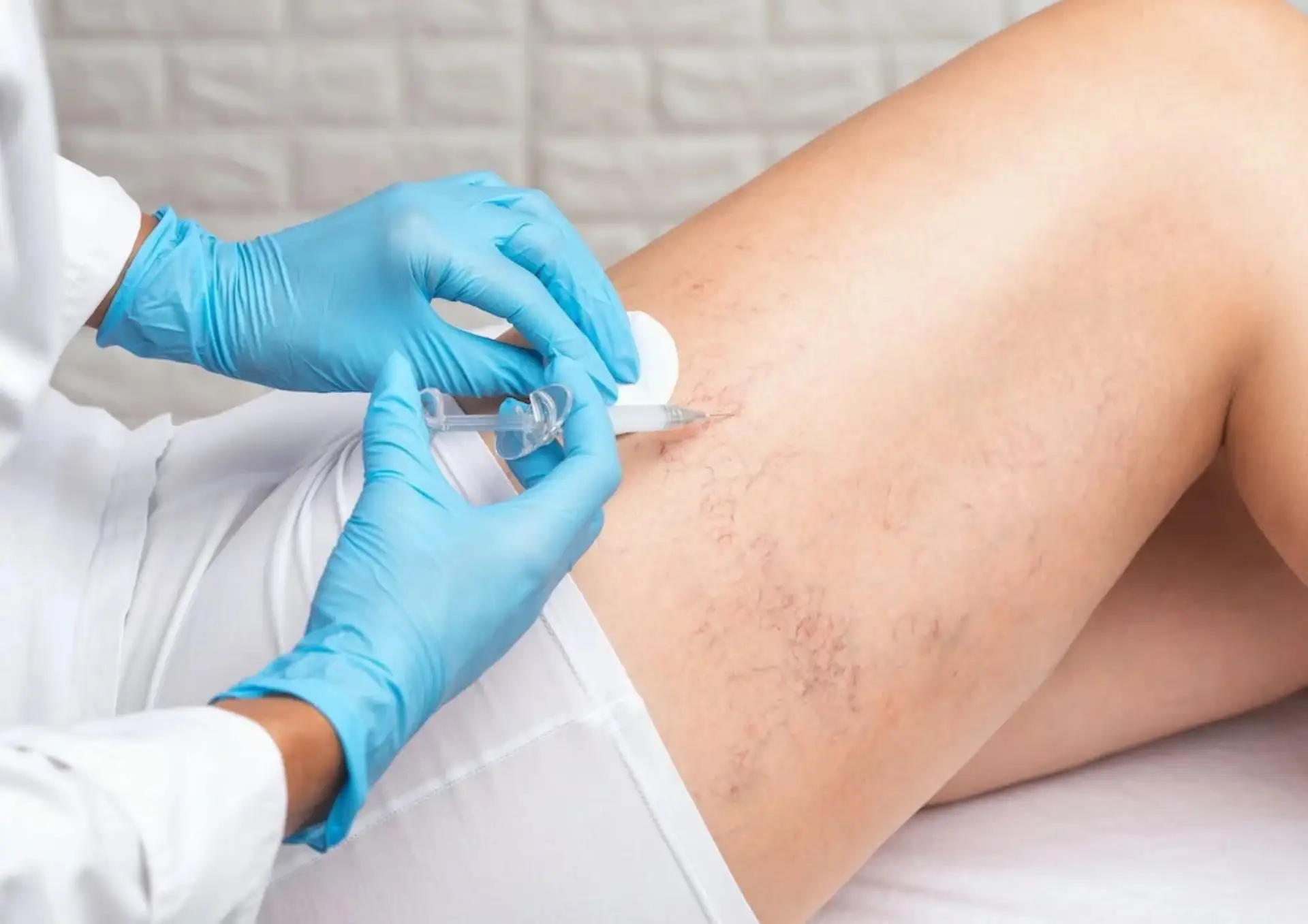 7 Escleroterapia - Imagen 1